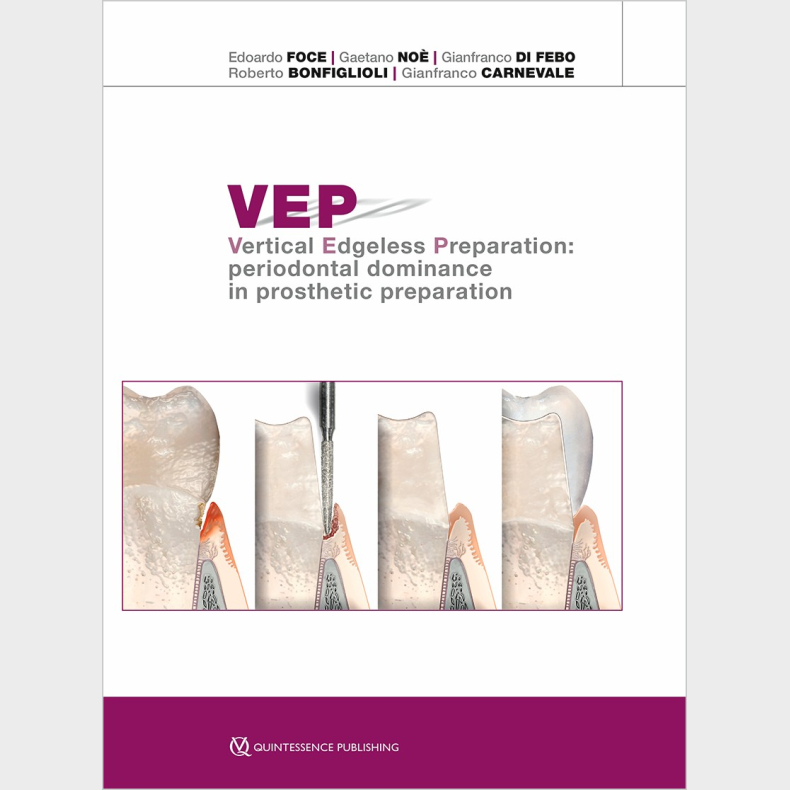 VEP Vertical Edgeless Preparation