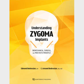 Understanding Zygoma Implants