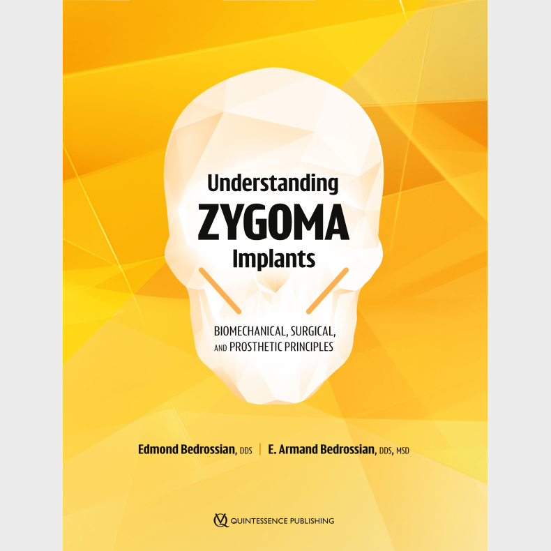 Understanding Zygoma Implants