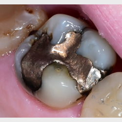 Comprehensive Composite � Posterior