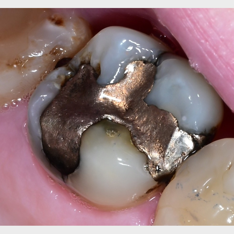 Comprehensive Composite � Posterior