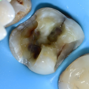 Comprehensive Composite � Posterior