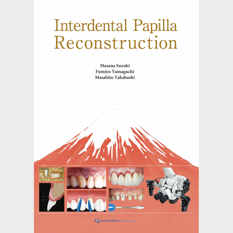 Interdental Papilla Reconstruction