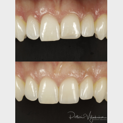 Forenklet stetik i fronten