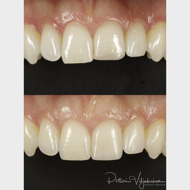 Forenklet stetik i fronten