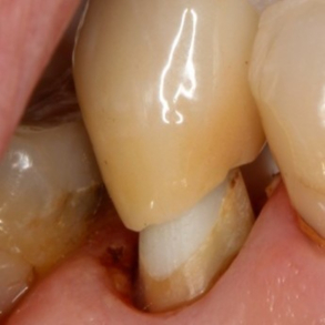 Vertikale pr�parationer - 