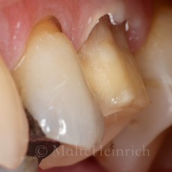 Vertikale pr�parationer - "Verti preps"