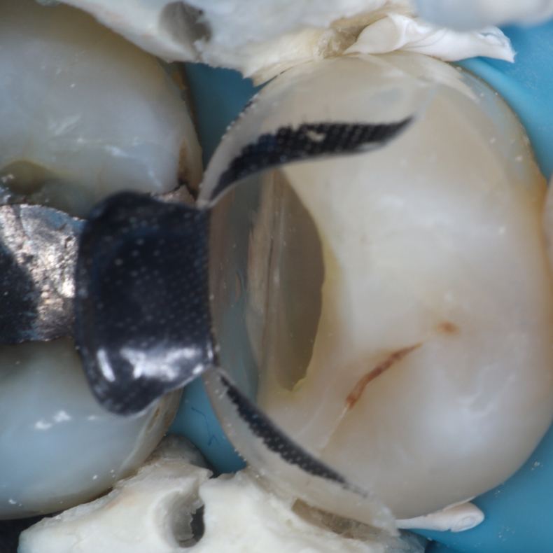 Comprehensive Composite � Posterior
