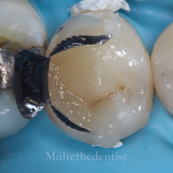Comprehensive Composite � Posterior