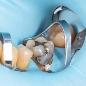 Masterclass - Hands-on Kofferdam