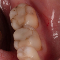 Diagnostics and treatment of infractions