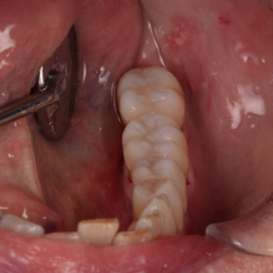Diagnostik og behandling af infraktioner