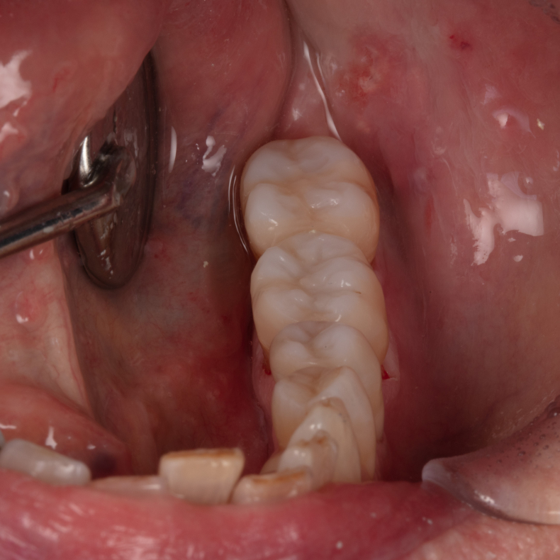 Diagnostik og behandling af infraktioner