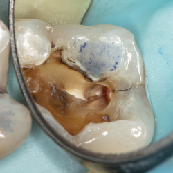 Diagnostik og behandling af infraktioner