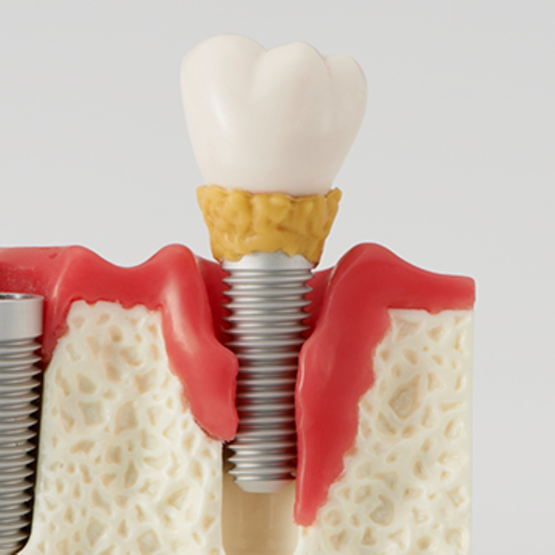 Peri-implantitis  diagnosticering og behandling