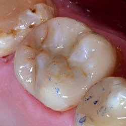 Comprehensive Composite � Posterior