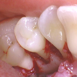 F succes med dine parodontitis-patienter - Modul 1