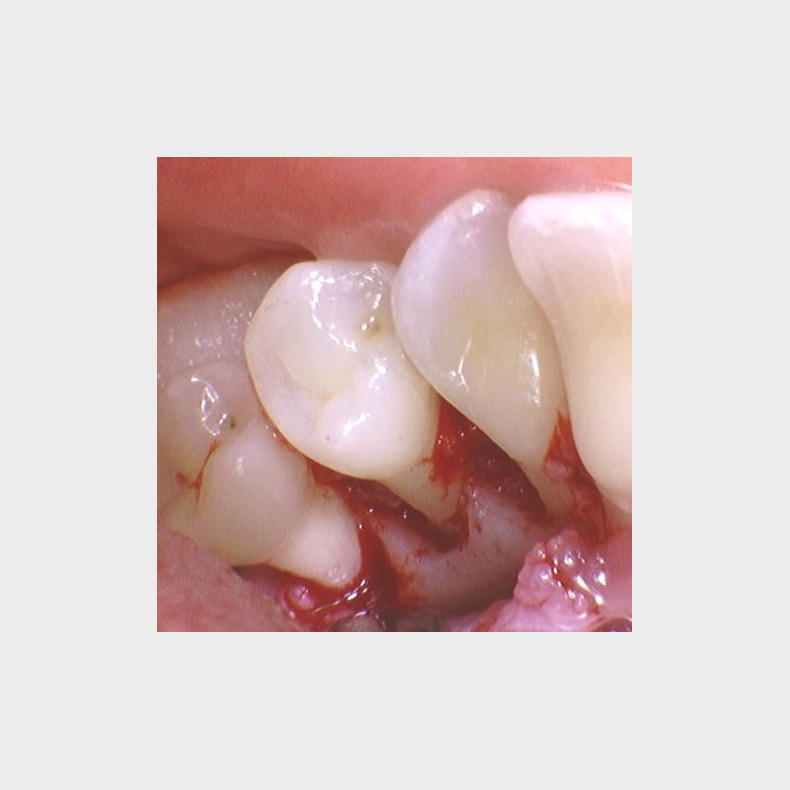 F succes med dine parodontitis-patienter - Modul 1