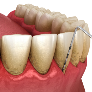 F succes med dine parodontitis-patienter - Modul 1