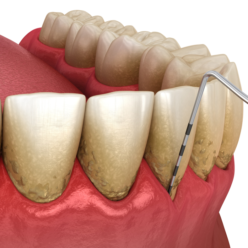 F succes med dine parodontitis-patienter - Modul 1