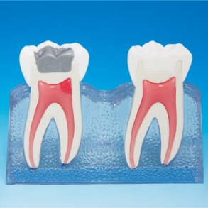 Behandling af fraktureret tand 