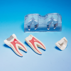 Behandling af fraktureret tand 