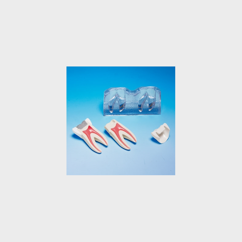 Behandling af fraktureret tand 