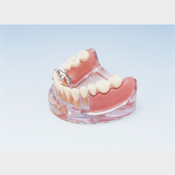 Implantat og delprotese 