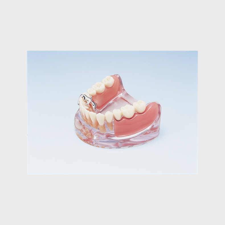 Implantat og delprotese 