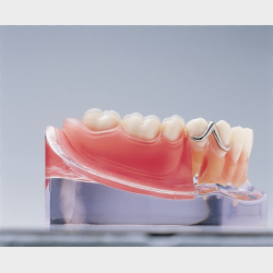 Implantat og delprotese 