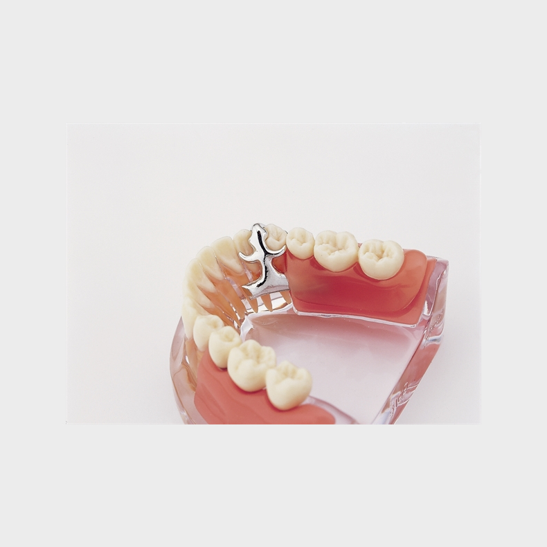 Implantat og delprotese 