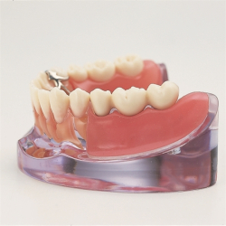 Implantat og delprotese 