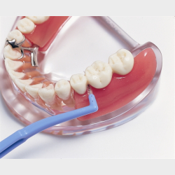 Implantat og delprotese 