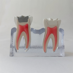 Behandling af fraktureret tand 