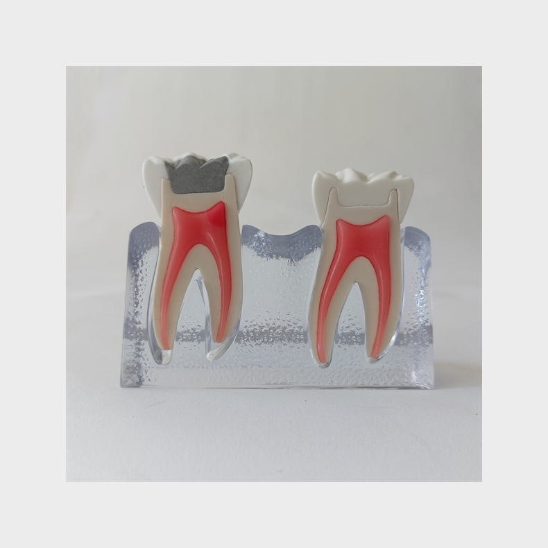 Behandling af fraktureret tand 