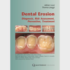 Dental Erosion