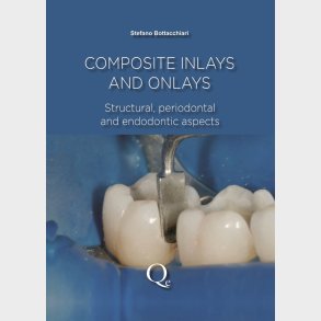 Composite Inlays and Onlays