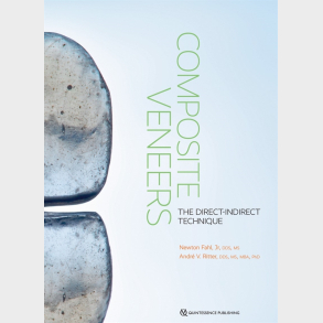 Composite Veneers The Direct-Indirect Technique