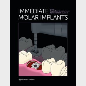 Immediate Molar Implants