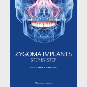Zygoma Implants