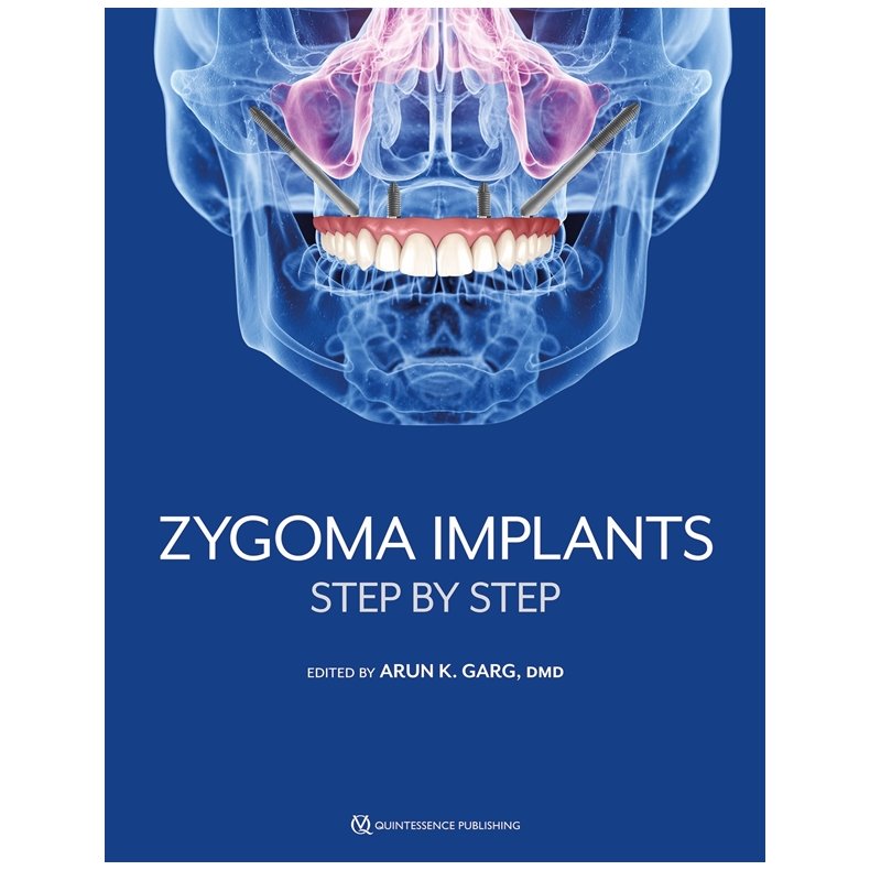 Zygoma Implants