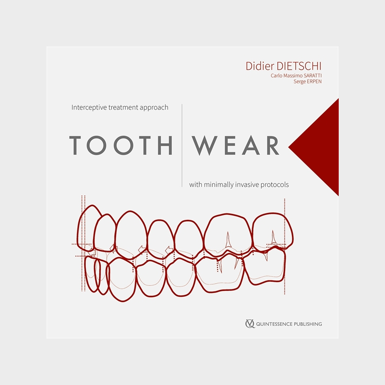 Tooth Wear