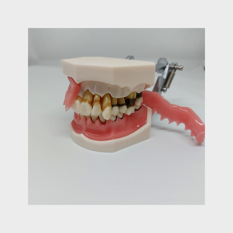 Parodontitis Studiemodel med Aftageligt Gingiva 