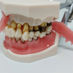 Parodontitis Studiemodel med Aftageligt Gingiva 