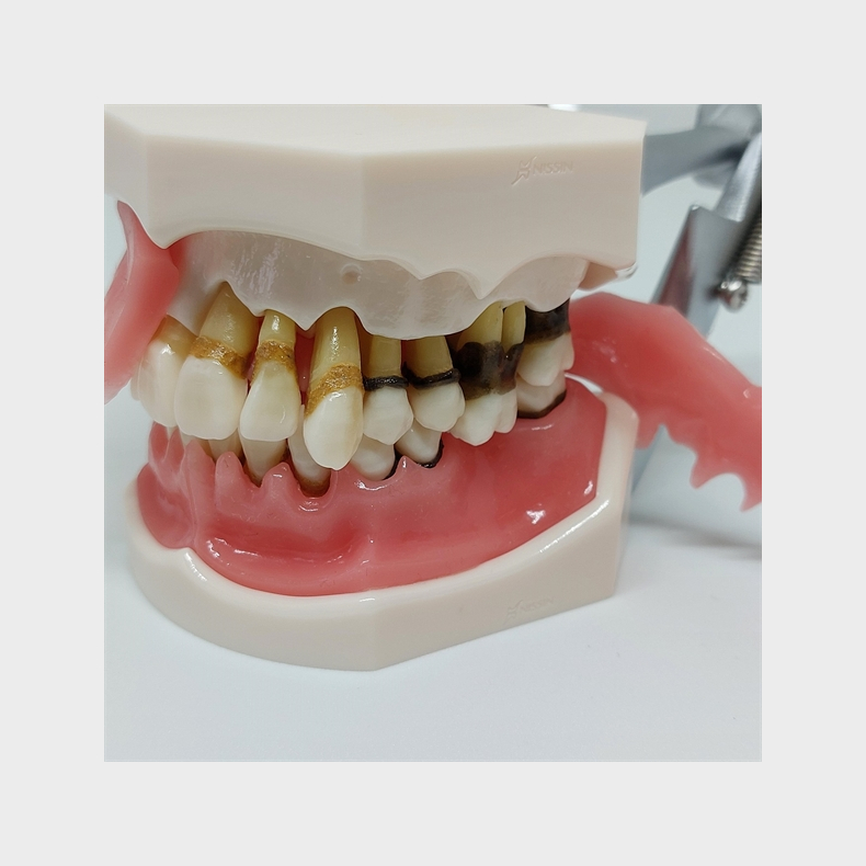 Parodontitis Studiemodel med Aftageligt Gingiva 