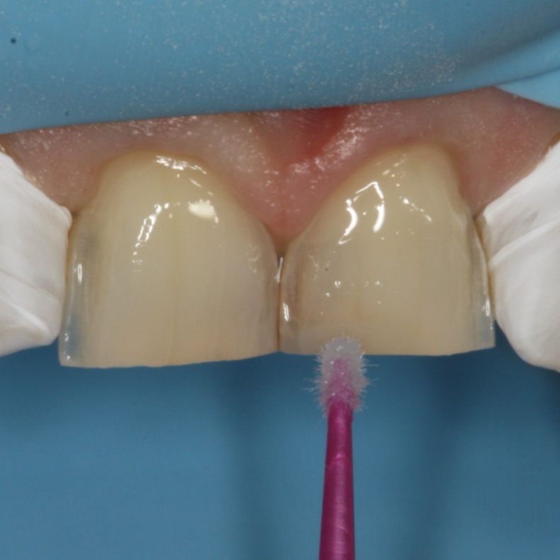 Bonding &amp; cementering - Har du pr�vet at g� op i limningen?