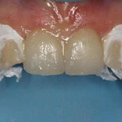 Bonding &amp; cementering - Har du pr�vet at g� op i limningen?