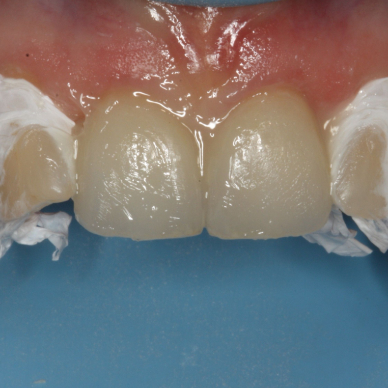 Bonding &amp; cementering - Har du pr�vet at g� op i limningen?