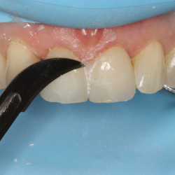 Bonding &amp; cementering - Har du pr�vet at g� op i limningen?