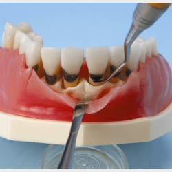Periodontisk trningsmodel